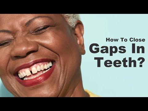Видео: Три лучших способа закрыть щели между зубами. Брекеты, композитные пломбы, виниры? Что выбрать? П...