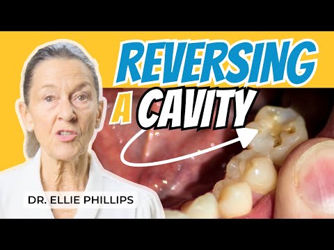 Видео: Как вылечить кариес и предотвратить его появление в будущем