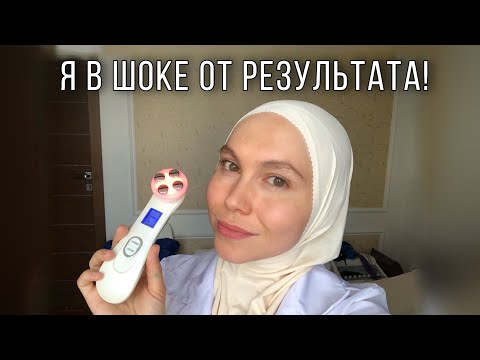 Видео: RF-лифтинг, электропорация (ДО и ПОСЛЕ)