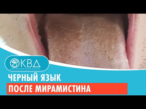 Видео: 👅 Черный язык после Мирамистина. Клинический случай №390