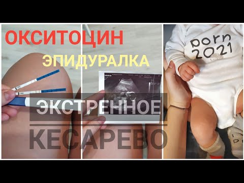 Видео: МОИ УЖАСНЫЕ РОДЫ | Прокол пузыря, окситоцин, эпидуралка, ЭКС | видео из роддома