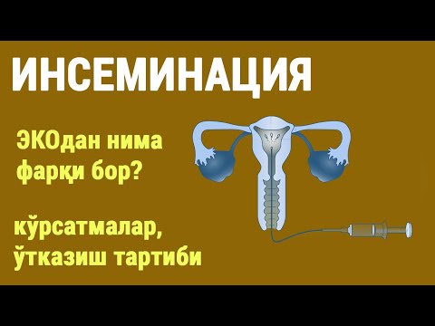 Видео: Инсеминация. ЭКОдан фарқи нима? Кўрсатмалар, ўтказиш тартиби.