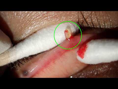 Видео: Я выдавил все ячмени! Эпизод 32