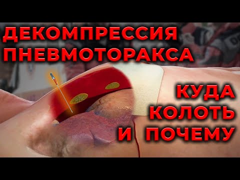 Видео: Пневмоторакс. Куда, как и почему вводить декомпрессионную иглу. #ПроСМП