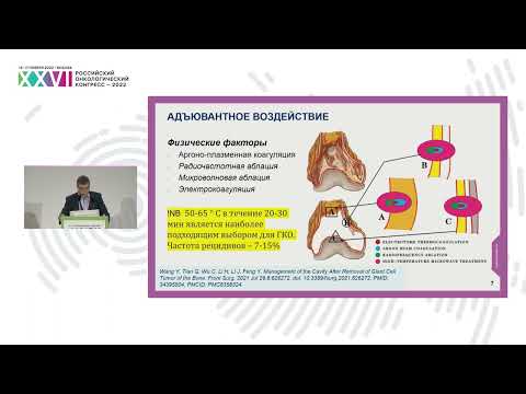 Видео: Роль хирургических методов в лечении гигантоклеточной опухоли кости