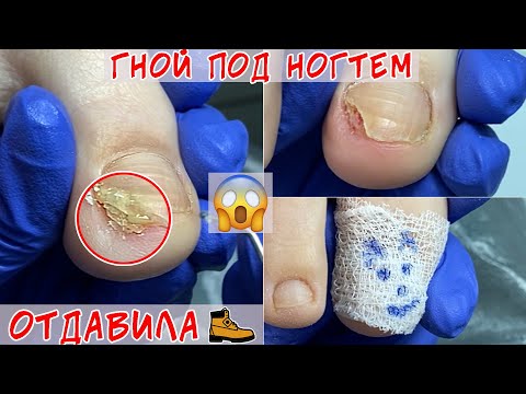 Видео: Гной под ногтем 😨 Отдавила ноготь, что делать?
