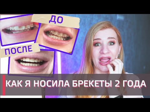 Видео: БРЕКЕТЫ - МОЯ ИСТОРИЯ /фото ДО и ПОСЛЕ, цены, нюансы/ О ЧЕМ ЖАЛЕЮ....