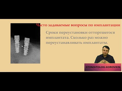 Видео: Сроки переустановки отторгшегося импланта. Как часто можно реимплантироваться. ЧЗВПИ.