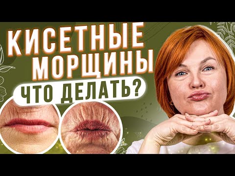 Видео: Кисетные морщины или морщины вокруг рта.  Как их убрать?