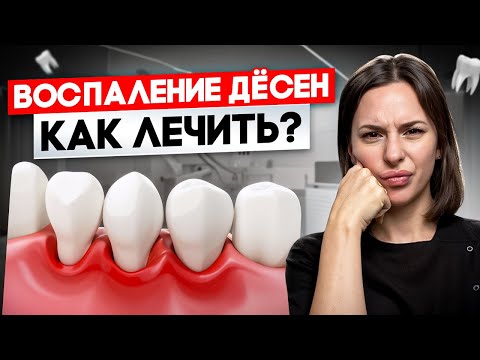 Видео: ЭТО ПОМОЖЕТ! Воспаление десны, гингивит и пародонтит | Как быть если кровоточат десна