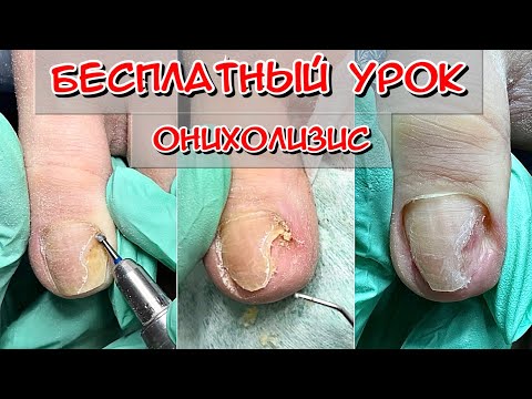 Видео: Зачистка онихолизиса / как делать зачистку онихолизиса / зачем делать зачистку / онихолизис
