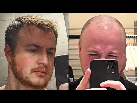 Видео: ЛЫСЕНИЕ 18 - 21 год