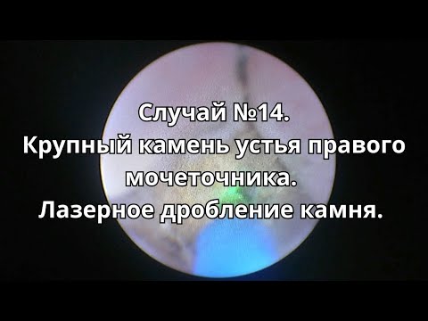 Видео: Случай #14. Контактная лазерная уретеролитотрипсия крупного камня устья правого мочеточника.