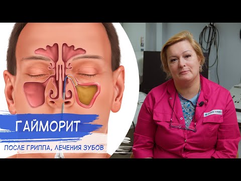 Видео: ГАЙМОРИТ ПОСЛЕ ГРИППА | Как лечить ГАЙМОРИТ