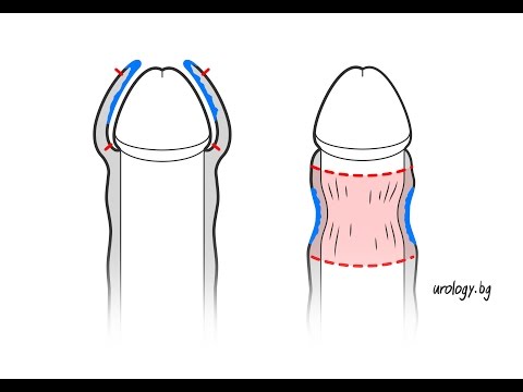 Видео: Фимоза и обрязване | Доц. Василев