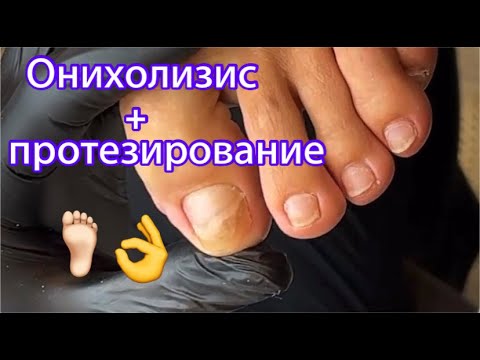 Видео: Онихолизис + протезирование 🦶🏻👌