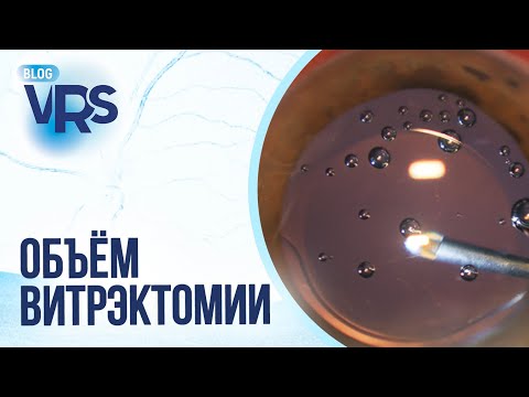 Видео: Сахарный диабет / Диабетическая ретинопатия / Объем витрэктомии