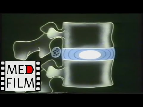 Видео: Остеохондроз позвоночника © Osteocondritis of the spine