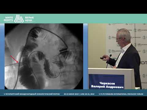 Видео: Применение магнитных анастомозов и стентирования при стриктурах желчных протоков (Черкасов В.А.)