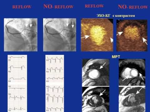 Видео: Лечение инфаркта миокарда часть 2   Кошкина Е.В