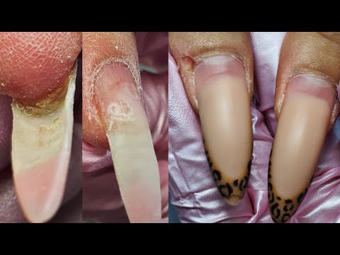 Видео: УЖАСС УЖАСННЫЙ😱/НОГОТЬ ОТОРВАЛСЯ ОТ НОГТЕВОГО ЛОЖА/ПЕРЕНОШЕННЫЕ НОГТИ