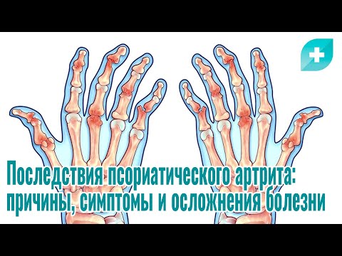 Видео: Последствия псориатического артрита: причины, симптомы и осложнения болезни