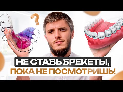 Видео: БРЕКЕТЫ – все, что нужно знать за 16 минут 33 секунд. Не наделай ошибок!