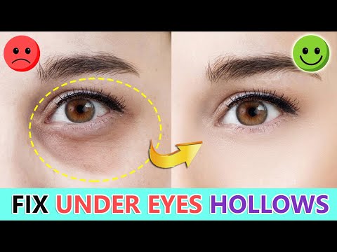 Видео: Подтяжка и заполнение впадин под глазами, исправление запавших глаз с темными кругами
