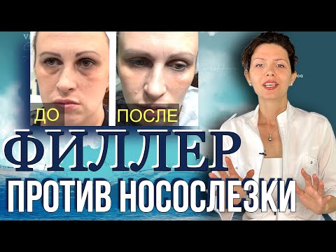 Видео: ФИЛЛЕРЫ и НОСОСЛЕЗНАЯ БОРОЗДА  👃💧💦  Заполнение Носослезной Борозды ФИЛЛЕРОМ  🔴 Наглядный Пример 🔴