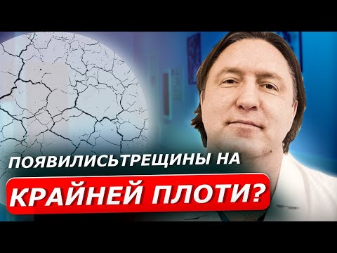 Видео: ТРЕЩИНЫ | Причины трещин на крайней плоти у мужчин. Они пройдут самостоятельно?