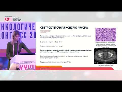Видео: Хондросаркома: редкие подтипы