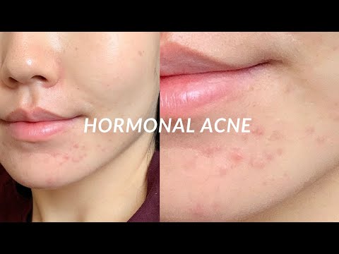 Видео: HORMONAL ACNE (миний зуны турш тэмцсэн гормоны батганы түүх болон хэрхэн эдгээсэн тухай 🤩)