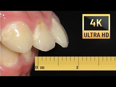 Видео: 🦷😁Стърчащи горни зъби, лечение на 4K резолюция❗