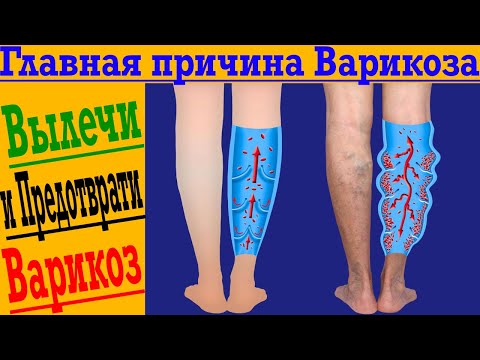 Видео: Как избавиться и предотвратить ВАРИКОЗ?!