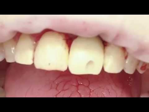 Видео: Изготовление временной коронки на имплант прямым методом
