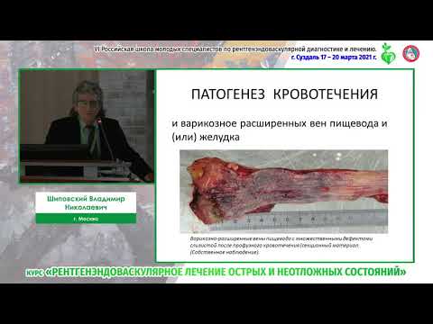 Видео: Портальная гипертензия (диагностика и лечение). Взгляд эндоваскулярного хирурга.