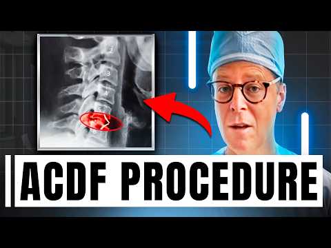 Видео: Процедура ACDF | Все, что вам нужно знать