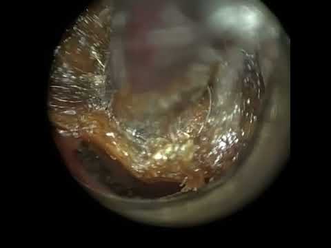 Видео: 260 — удаление ушной серы ватным тампоном с помощью WAXscope®️