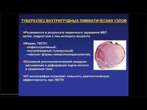 Видео: Туберкулез органов дыхания