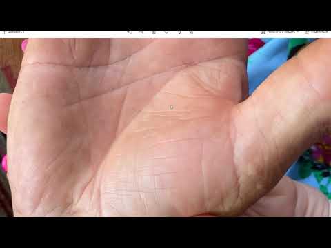 Видео: Здоровье на руке, инсульт, разрыв на линии жизни. Опасность для жизни. Как посмотреть? Хиромантия