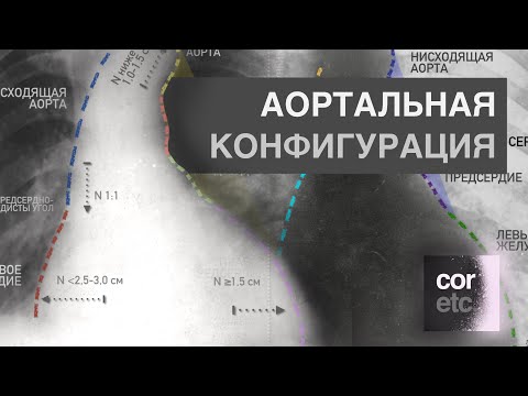 Видео: Рентген сердца: Синдром аортальной конфигурации сердца.
