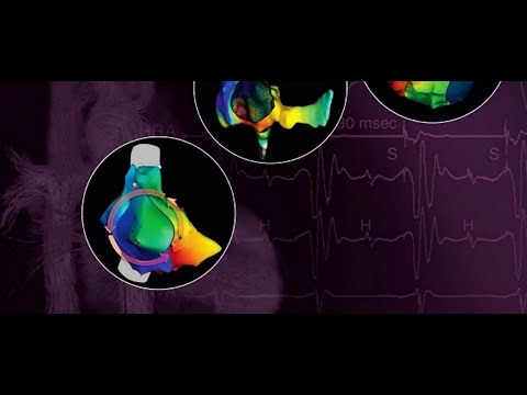 Видео: Предсердные тахикардии  Электрофизиология для клиницистов и врачей функциональной диагностики