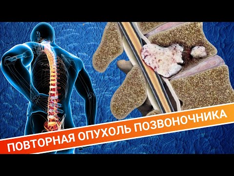 Видео: ВТОРИЧНАЯ ОПУХОЛЬ ПОЗВОНОЧНИКА