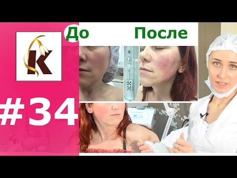 Видео: Нити с насечками для подтяжки лица, До и ПОСЛЕ, очень эффективный метод