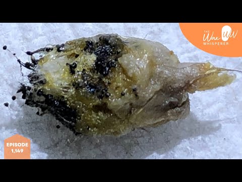 Видео: 1,149 - Удаление грибка в ухе