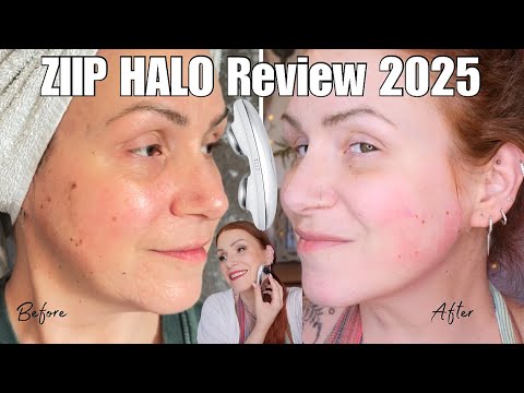 Видео: Обзор ZIIP HALO для коррекции щек и обвисшей кожи спустя 1 год + До и После