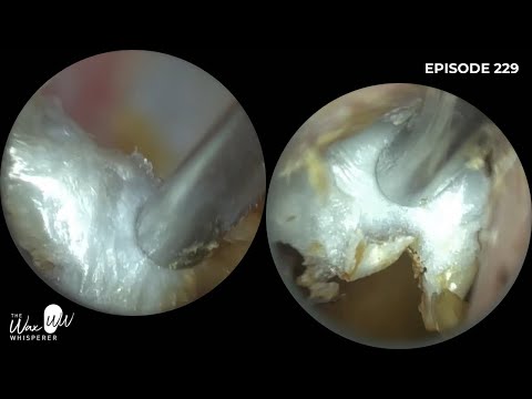 Видео: 229 - Пациент обратился с подозрением на доброкачественный #остеонекроз и #отомикоз.