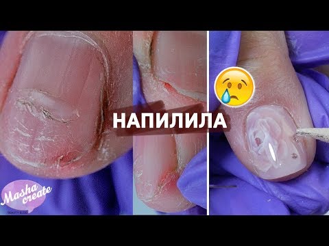 Видео: БОЛИТ под ногтем, допилились!  Наращивание ногтей БЕЗ форм. Аппаратный маникюр: грубая кожа