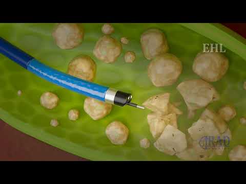 Видео: Чрескожная холангиоскопия, литотрипсия и удаление камней из желчного пузыря