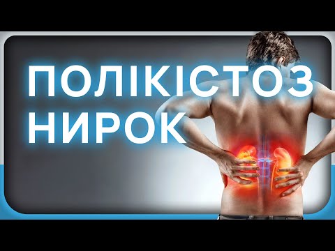 Видео: Що таке полікістоз нирок? Чи потрібен діаліз при цьому захворюванні?